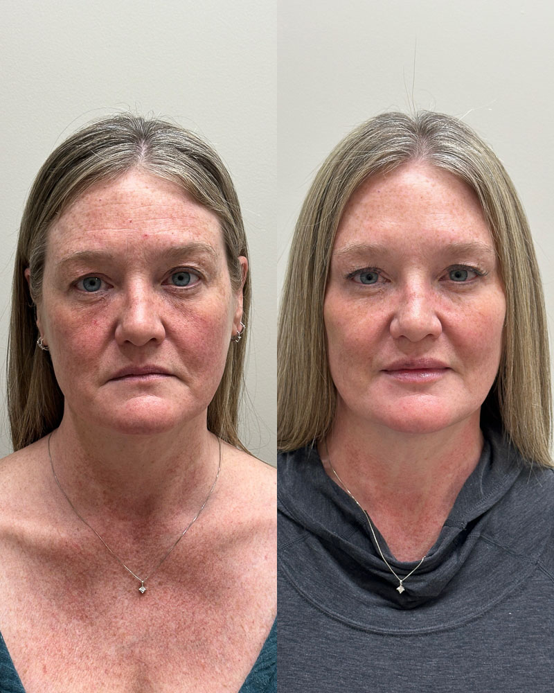 Before after of dehydrated skin.