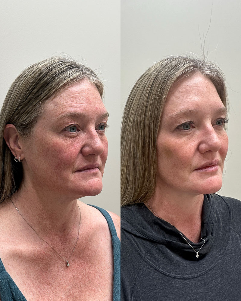 Before after of dehydrated skin near Mesa, AZ. 