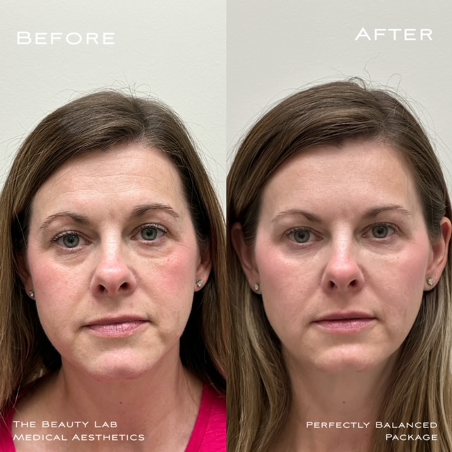 Before and after of dermal fillers under eyes. 