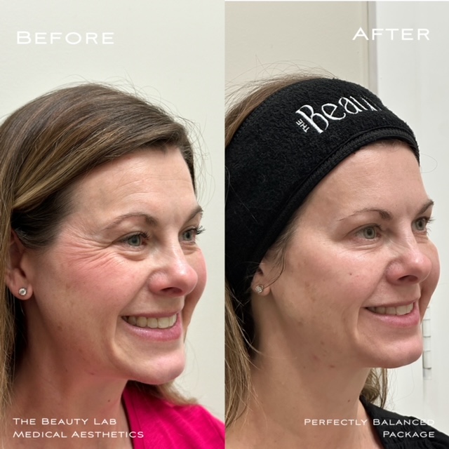 Before and after dermal fillers for cheeks.  
