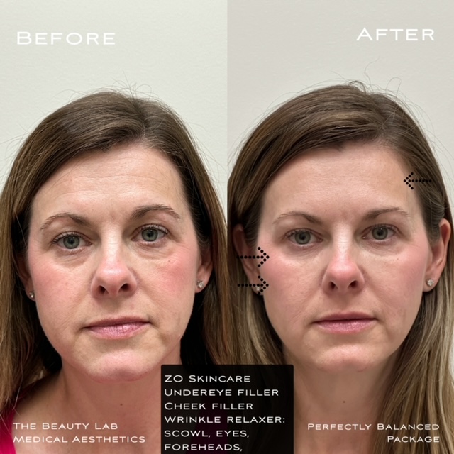 Before and after perfectly balanced package to include undereye filler, cheek filler, wrinkle relaxer, scowl, eyes, foreheads in Mesa, AZ. 