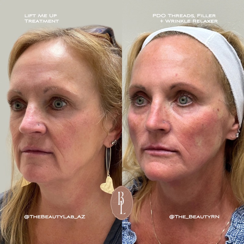 Before and after results of anti-aging treatment showing skin texture and tone improvement on mature skin.