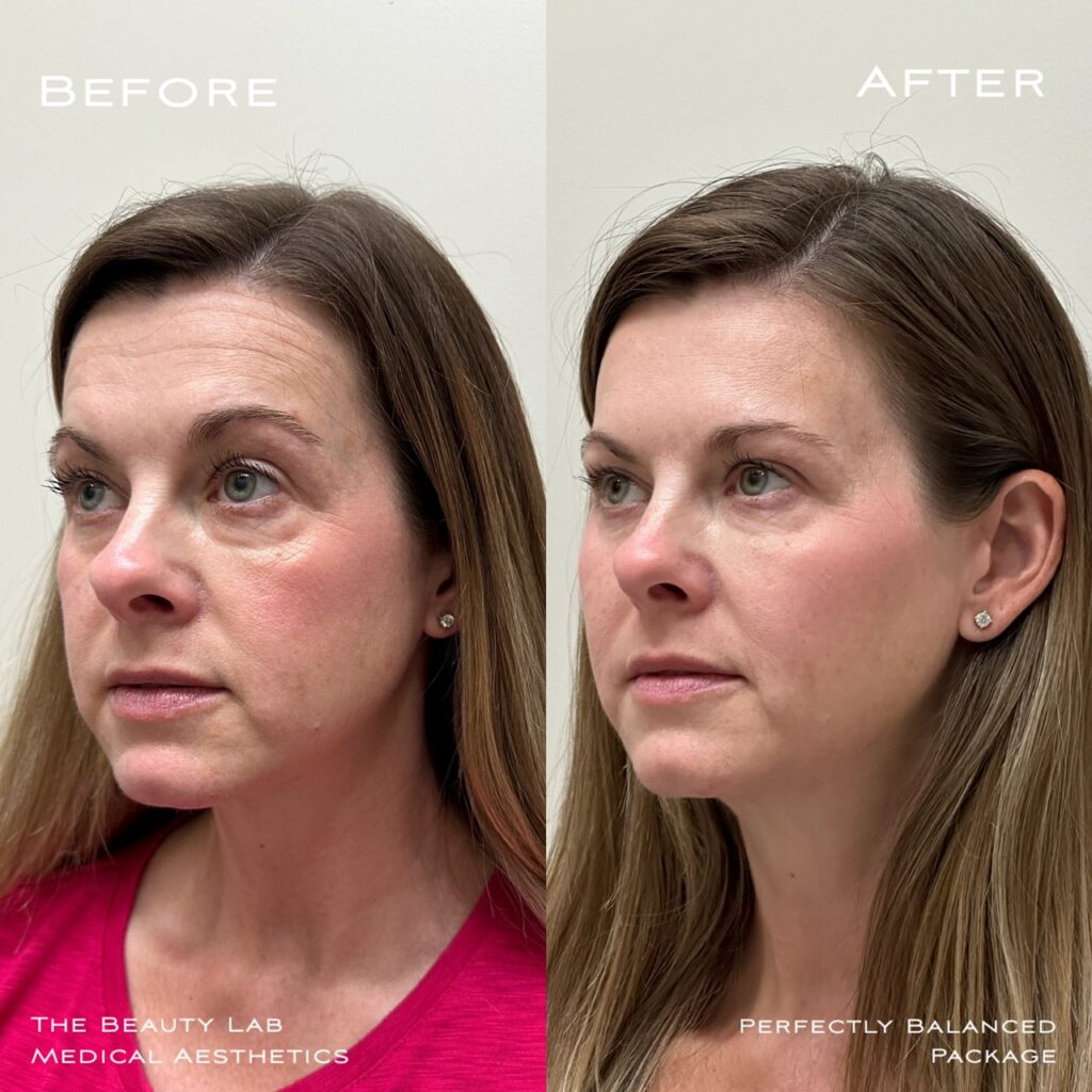 Before and after comparison showcasin.g results of facial treatment from side profile view.