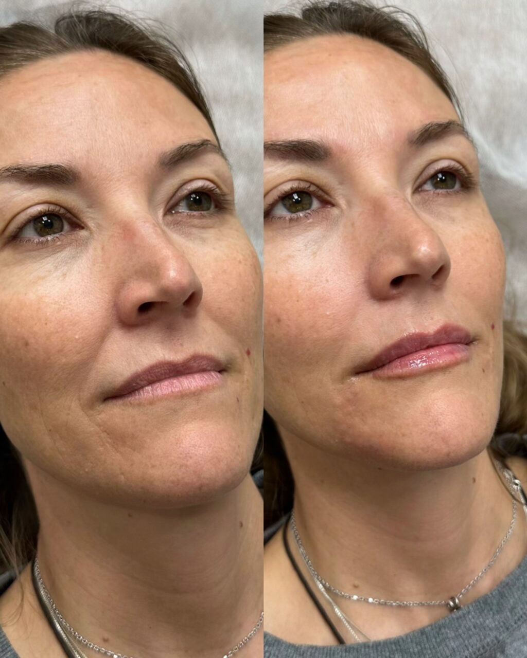 Clinical results showing the effects of professional skin treatment with upward angle view.