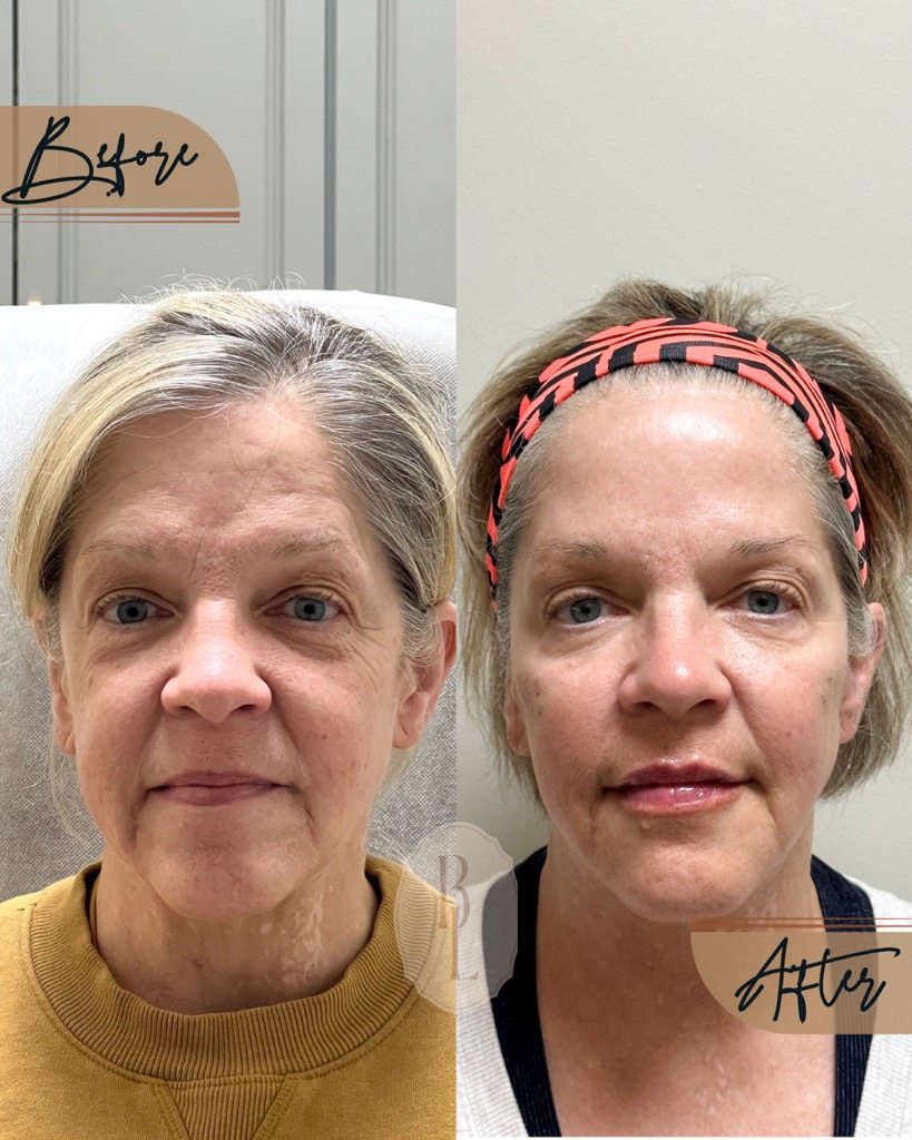 Before and after results of wrinkle relaxer treatment showing improvement in facial lines.