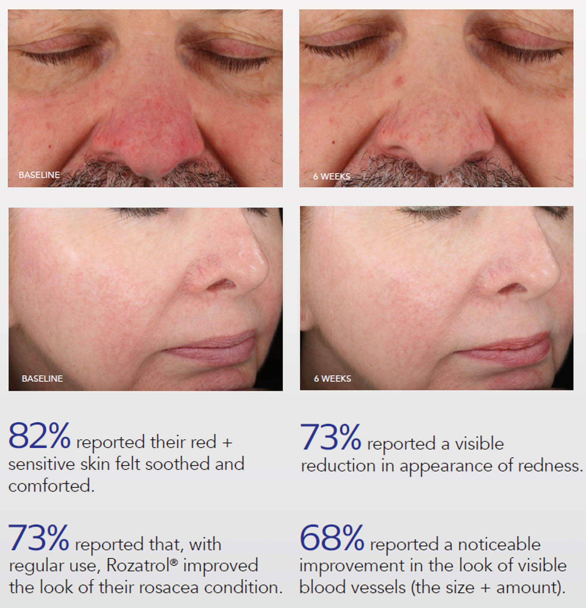 Before/after comparison showing ZO Skin Health rosacea treatment results with improvement statistics for redness, texture, and visible blood vessels.