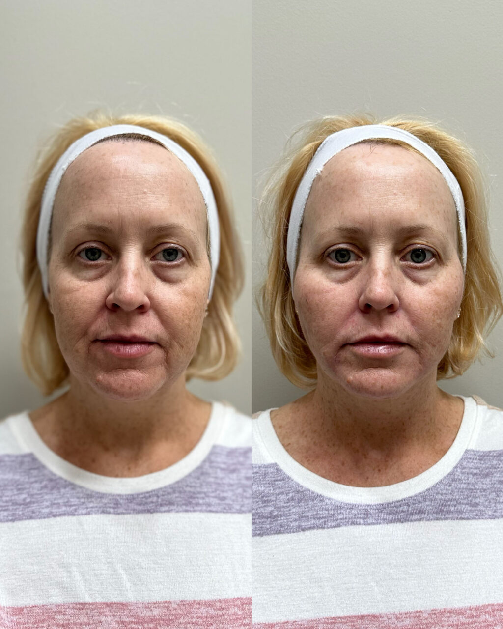 Before and after pdo threads