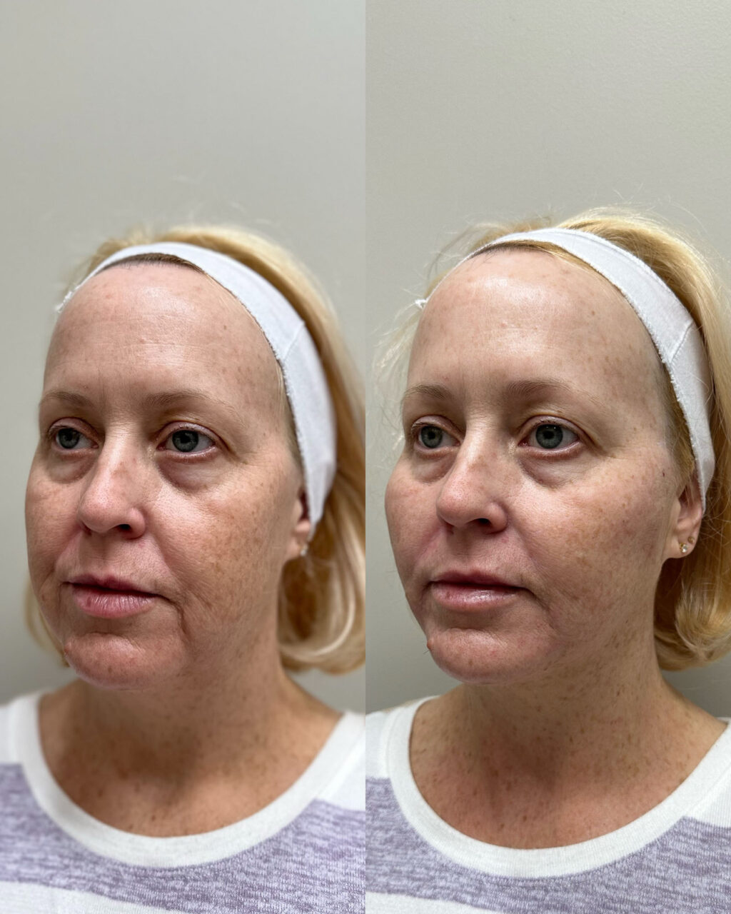 Before and after pdo threads