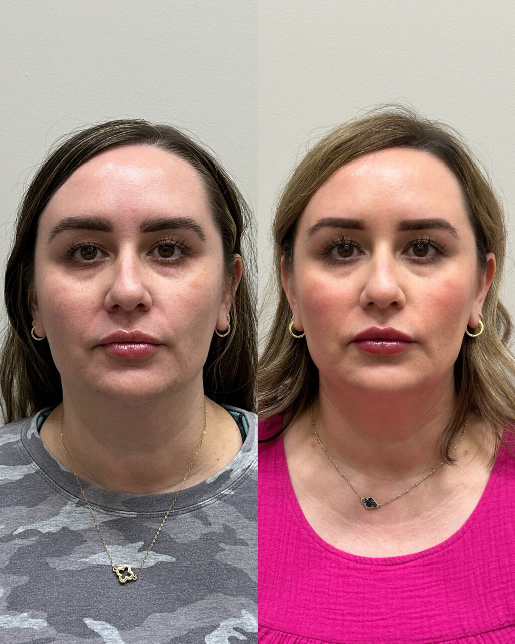 before and after of lip filler
