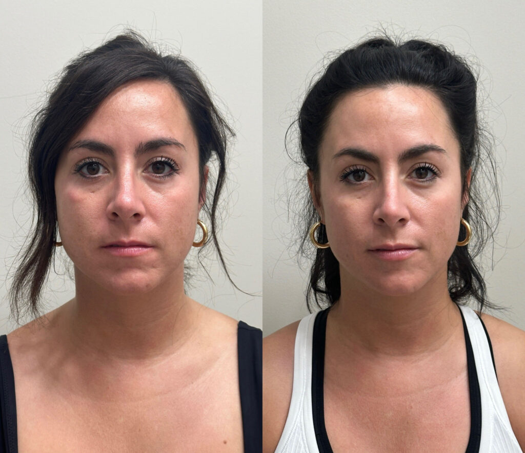 before and after of lip filler