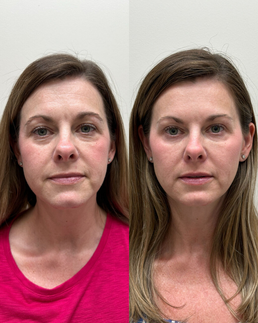 Before and after of chin filler