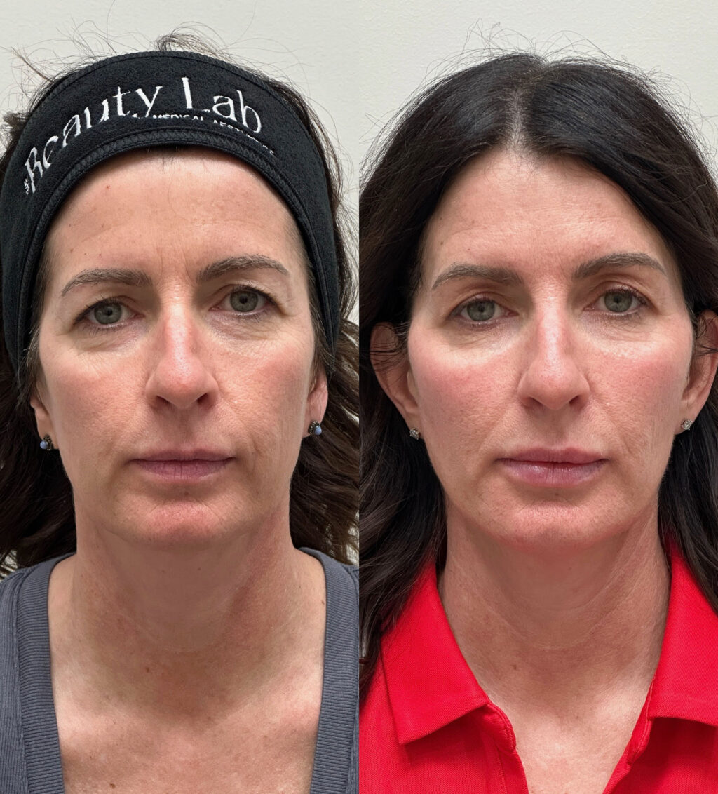 Before and after of under eye filler