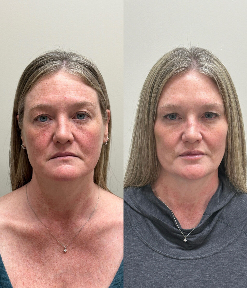 Before and after of jawline filler