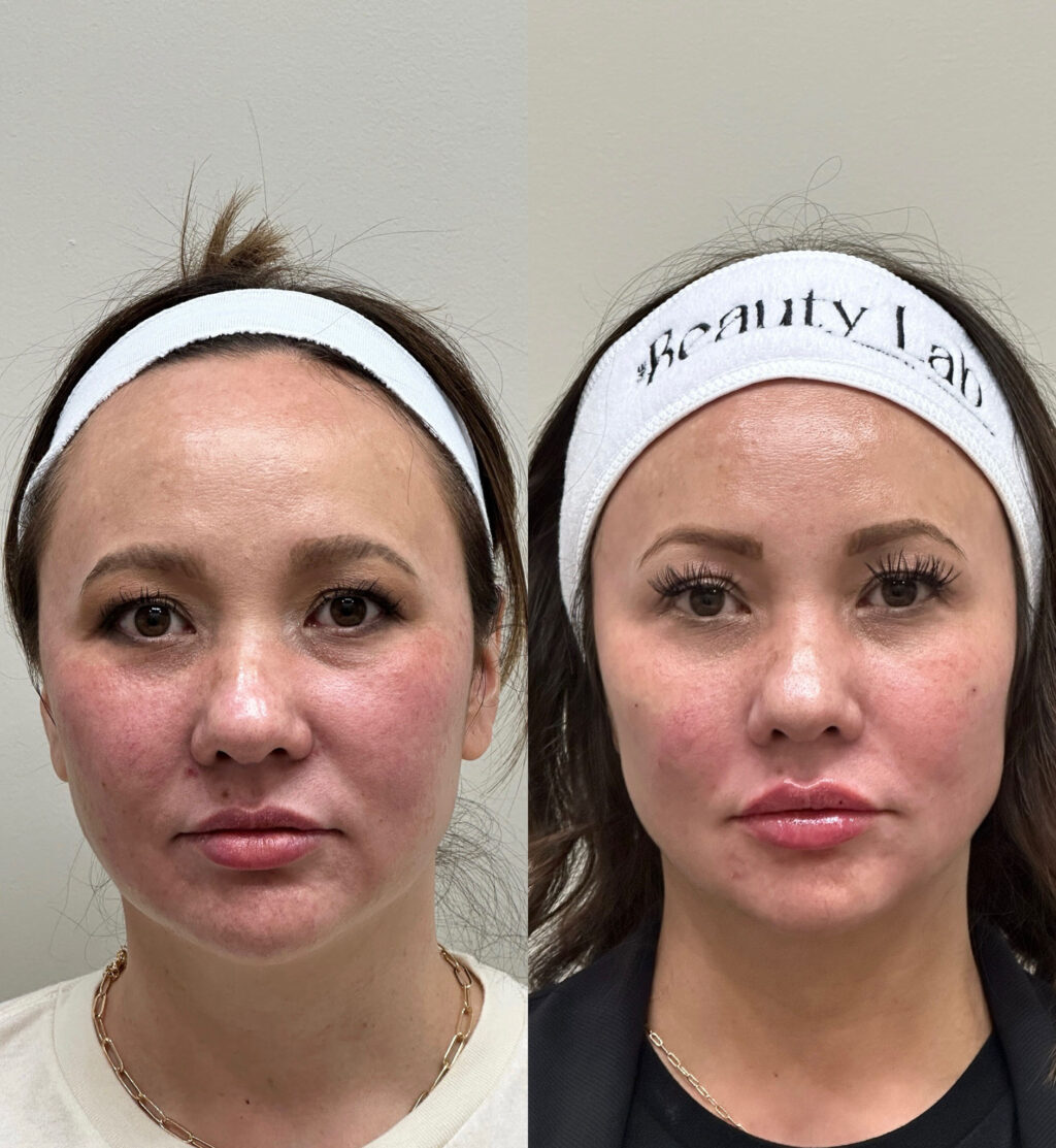 before and after PRF treatment