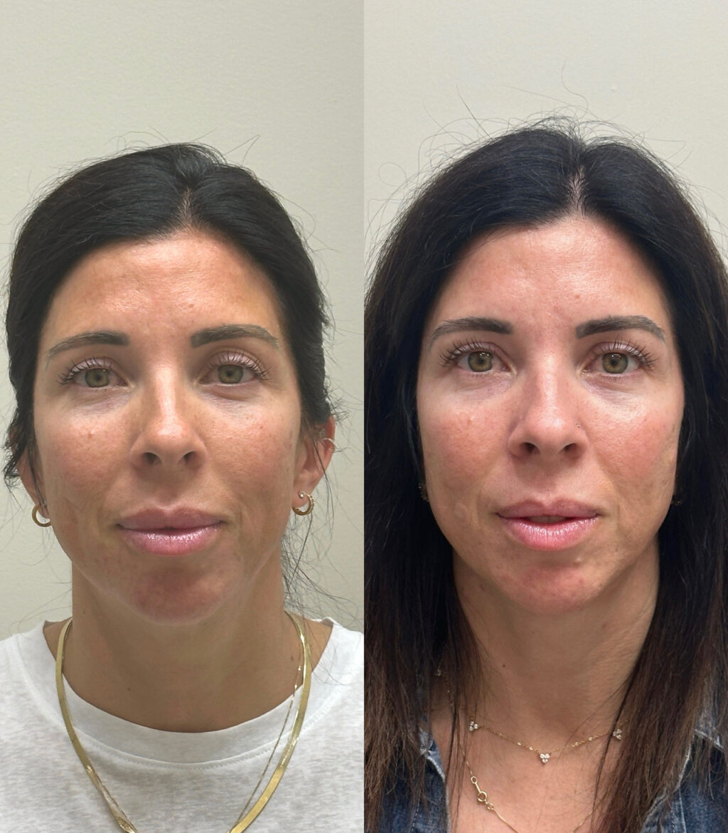 Before and after of Sculptra treatment. 