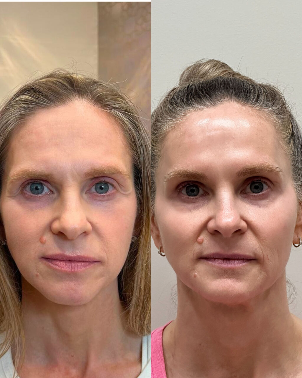 Before and after of dermal filler treatment. 