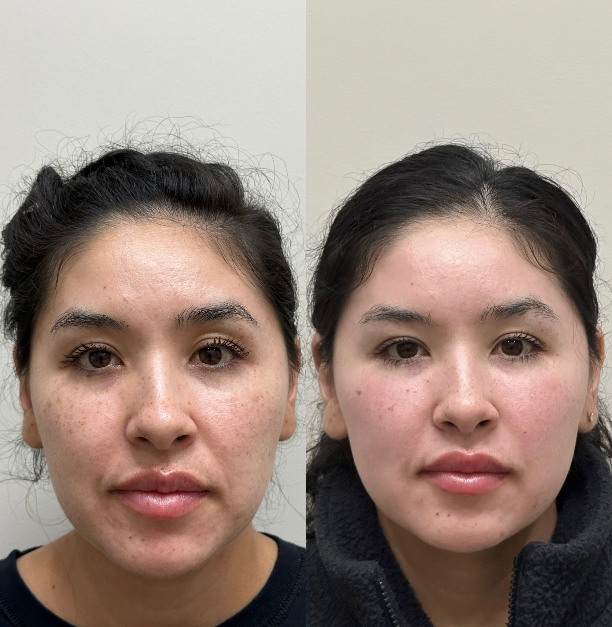 Under eye rejuvenation before and after using prf gel treatment.