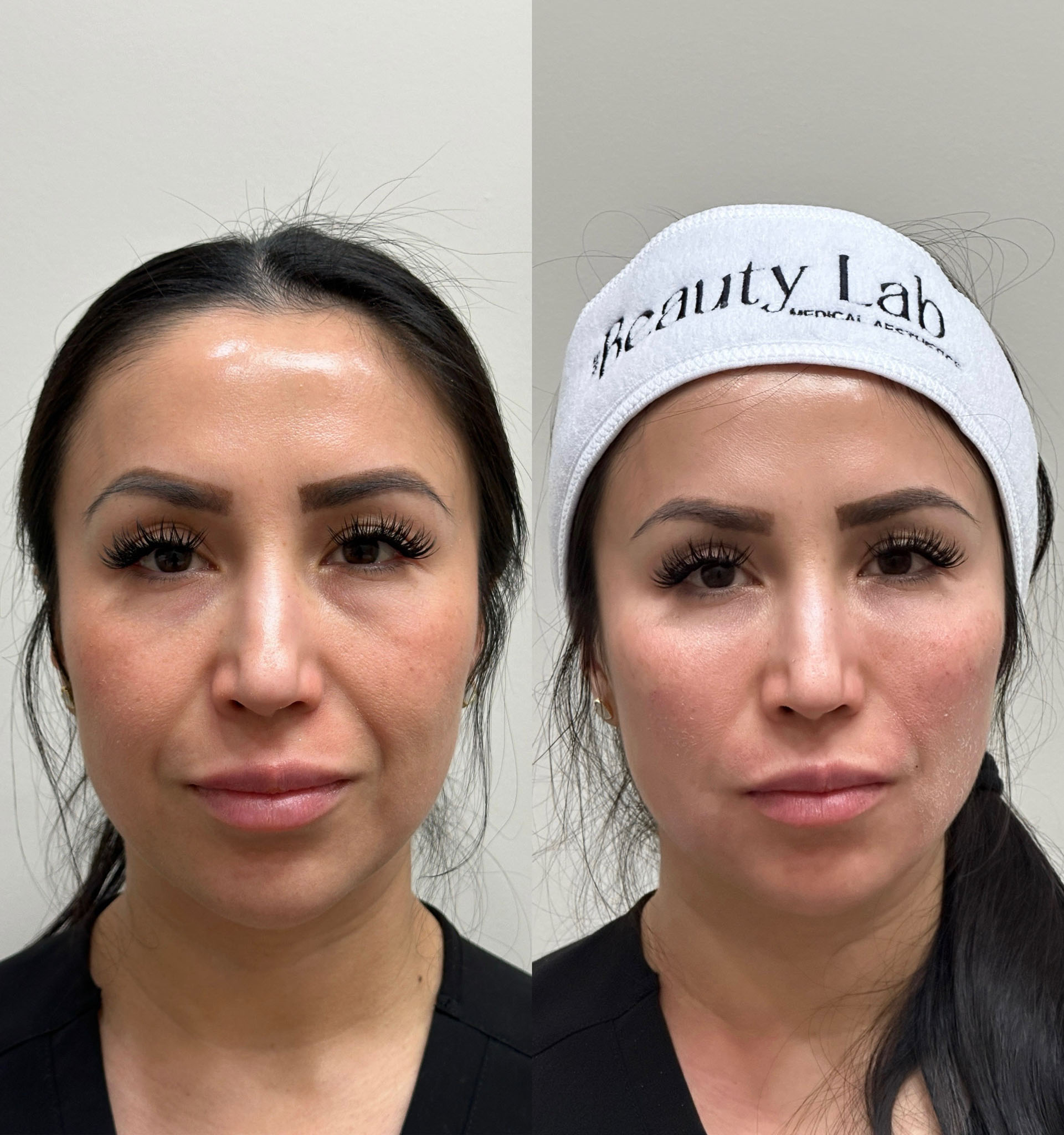 Before and after prf gel under eyes treatment results.
