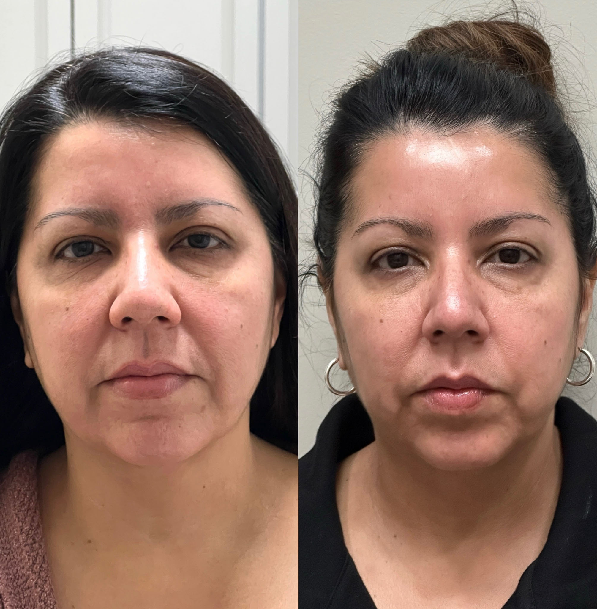 Dermal filler under eyes before and after results.