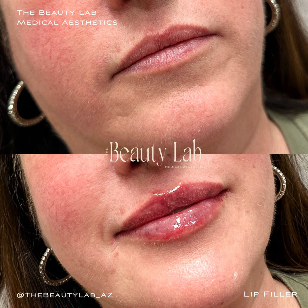 Best lip filler results showing enhanced kissable lips in Mesa, AZ.