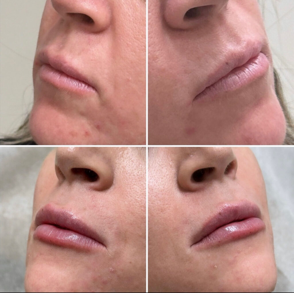 Lip filler before and after photos showing dramatic enhancement results.
