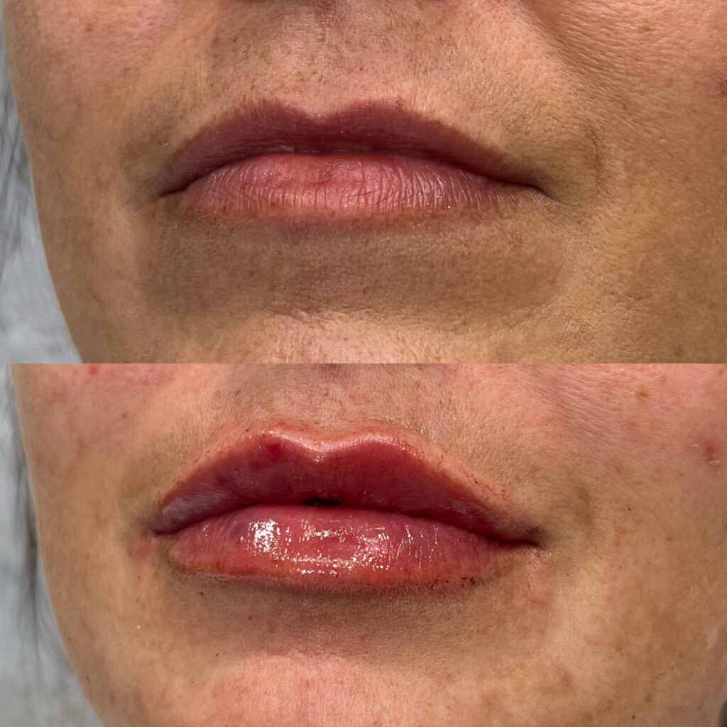 Enhanced kissable lips from lip filler near Mesa AZ treatment.
