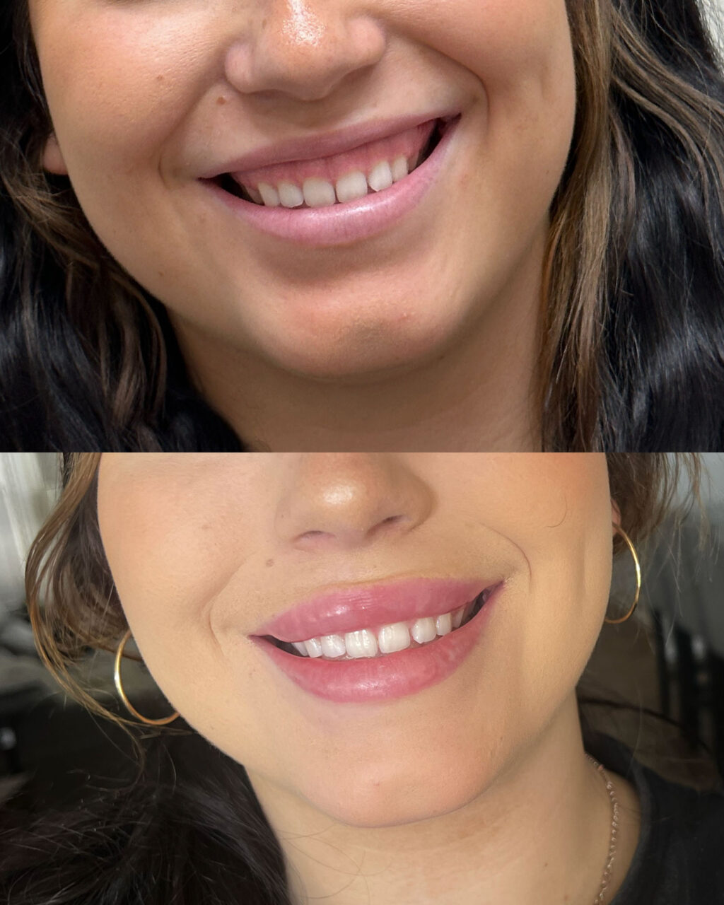 Kissable lips with lip filler and botox for smile lines in Mesa, AZ.