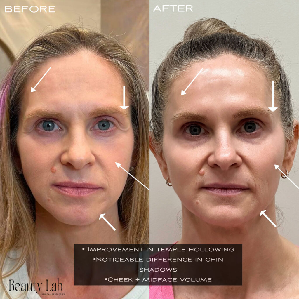 Before and after of client with Sculptra
